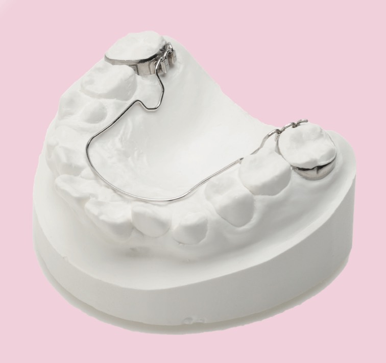 3Dリンガルアーチ