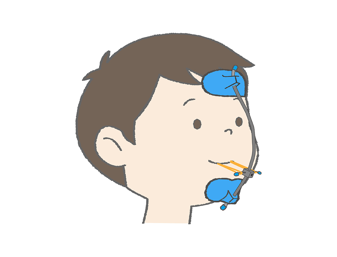 上顎前方牽引装置（フェイスマスク）