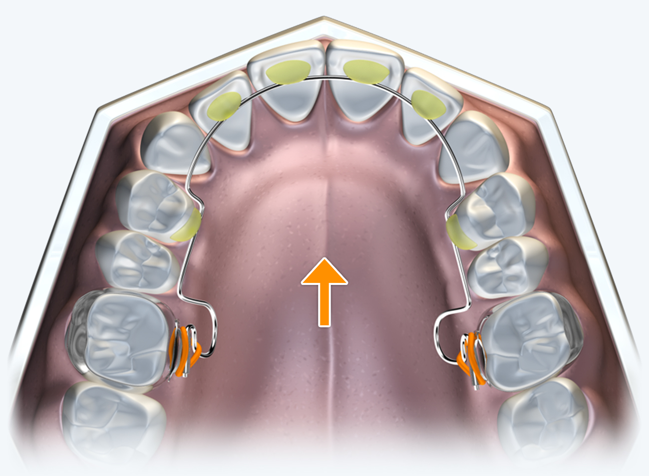 BWS（Bent Wire System）